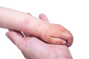 Austin Allergy - Eczema