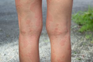 Austin Allergy - Hives
