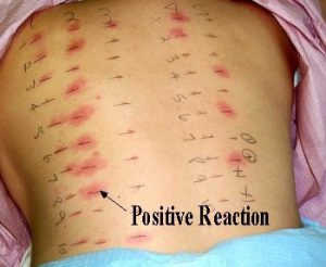 Austin Allergy - Positive Reaction